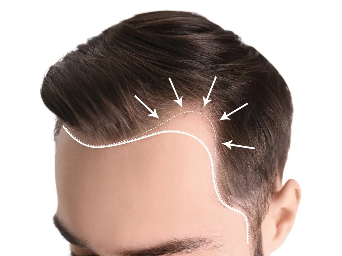 The Role of Scalp Micropigmentation in Restoring Hairline Appearance